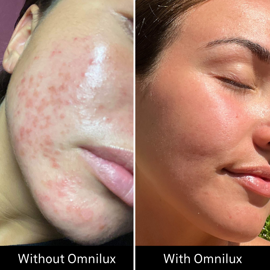 Omnilux Clear - The Luxe Medspa