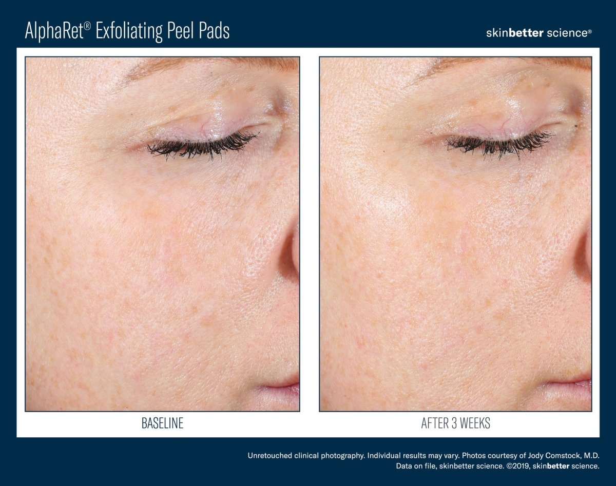 AlphaRet Exfoliating Peel Pad - Single Pad SkinBetter Science - The Luxe Medspa