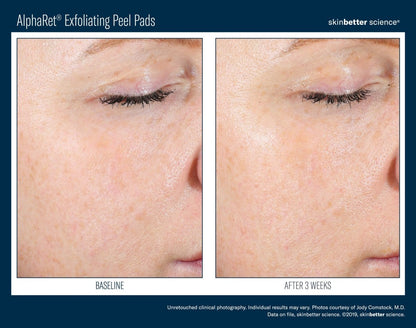 AlphaRet Exfoliating Peel Pad - Single Pad SkinBetter Science - The Luxe Medspa