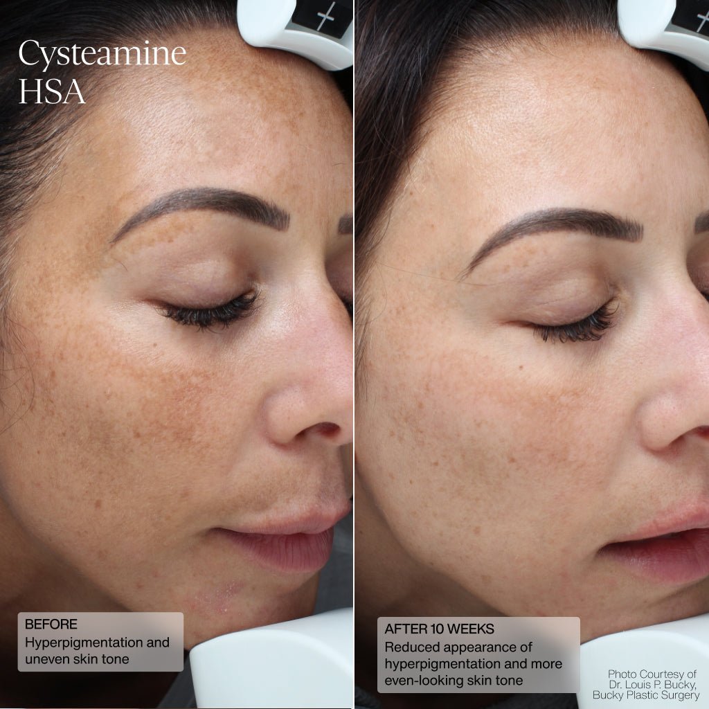 Cysteamine HSA Pigment & Tone Corrector Senté - The Luxe Medspa