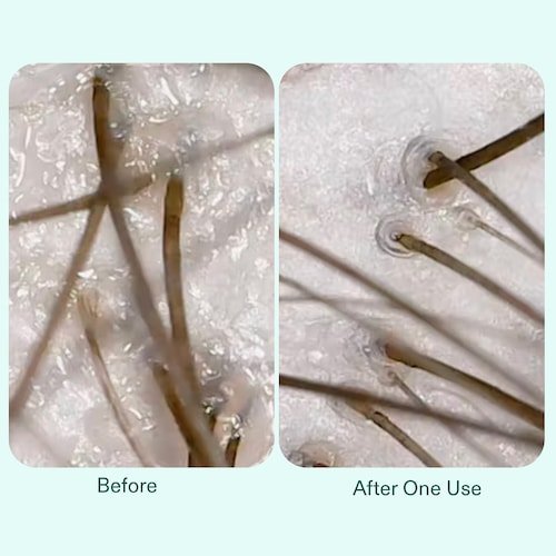 Nutrafol Build - Up Blocker Scalp Exfoliating Hair Mask Nutrafol - The Luxe Medspa