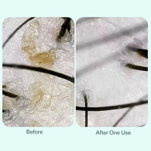 Nutrafol Build - Up Blocker Scalp Exfoliating Hair Mask Nutrafol - The Luxe Medspa