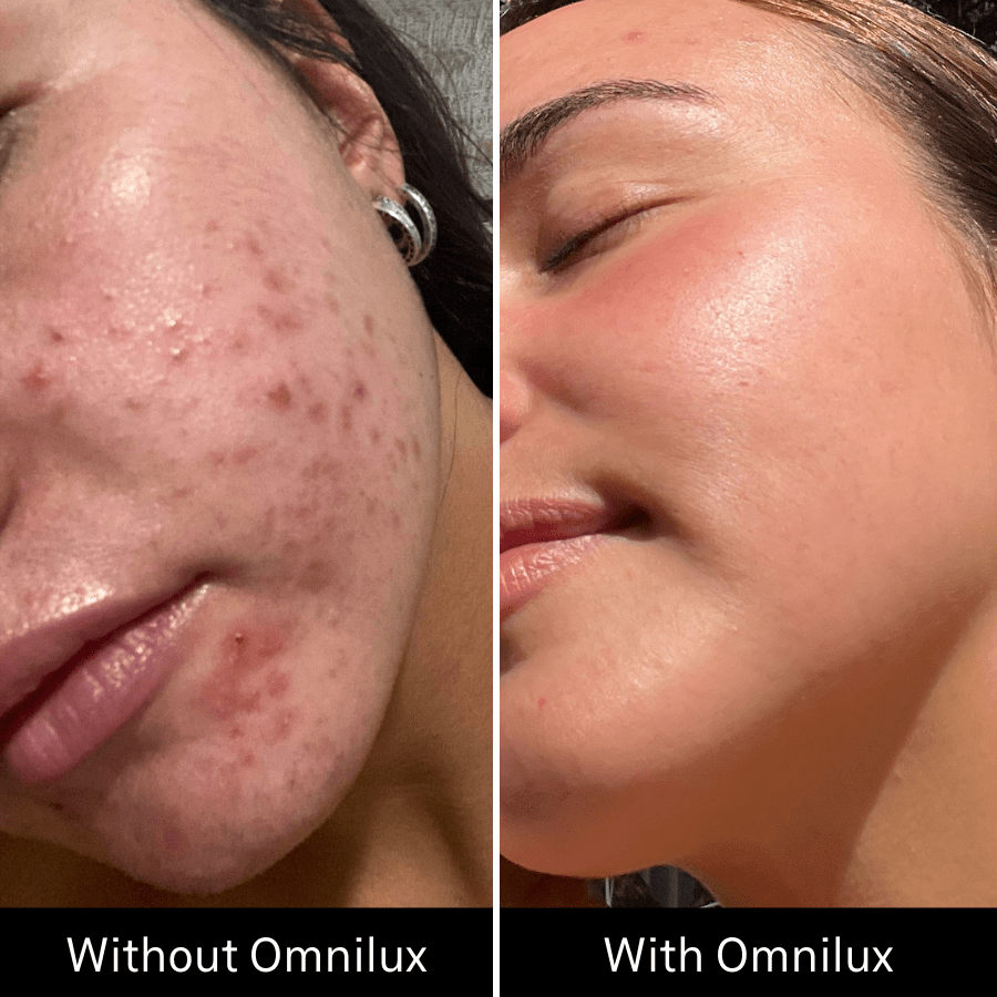 Omnilux Clear Omnilux - The Luxe Medspa